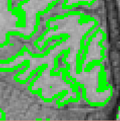 [Gray Matter Segmentation Overlayed]